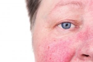 rosacea